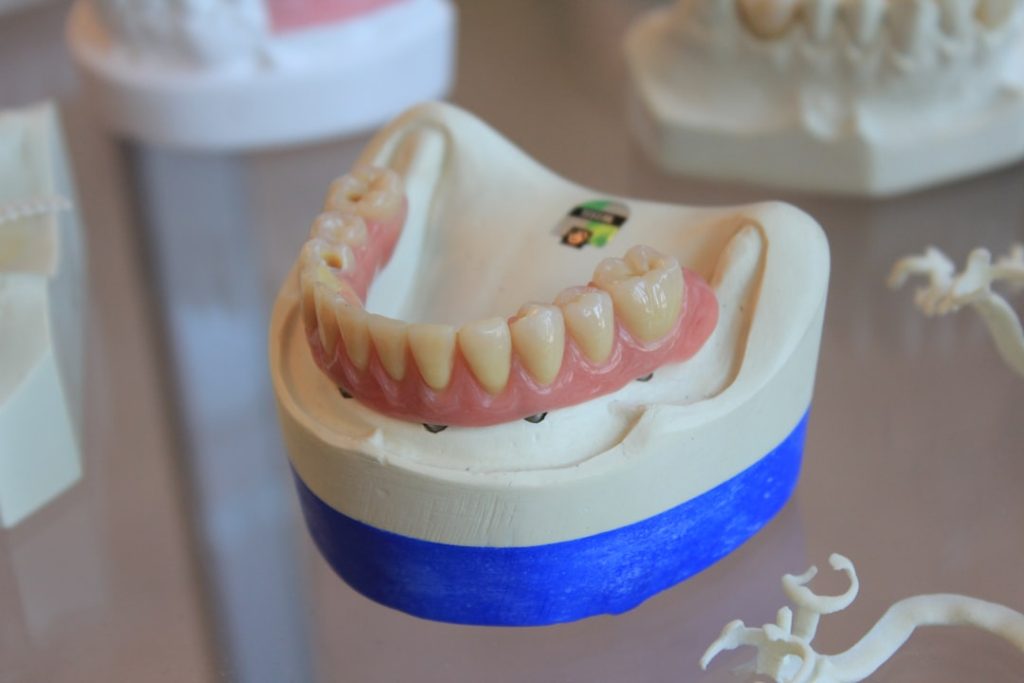 contact Butler Family Dental for your own dental implants